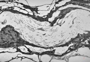 F,11y. | the wall of the arachnoid cyst